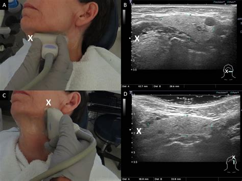 prada gland|picture of parotid gland swelling.